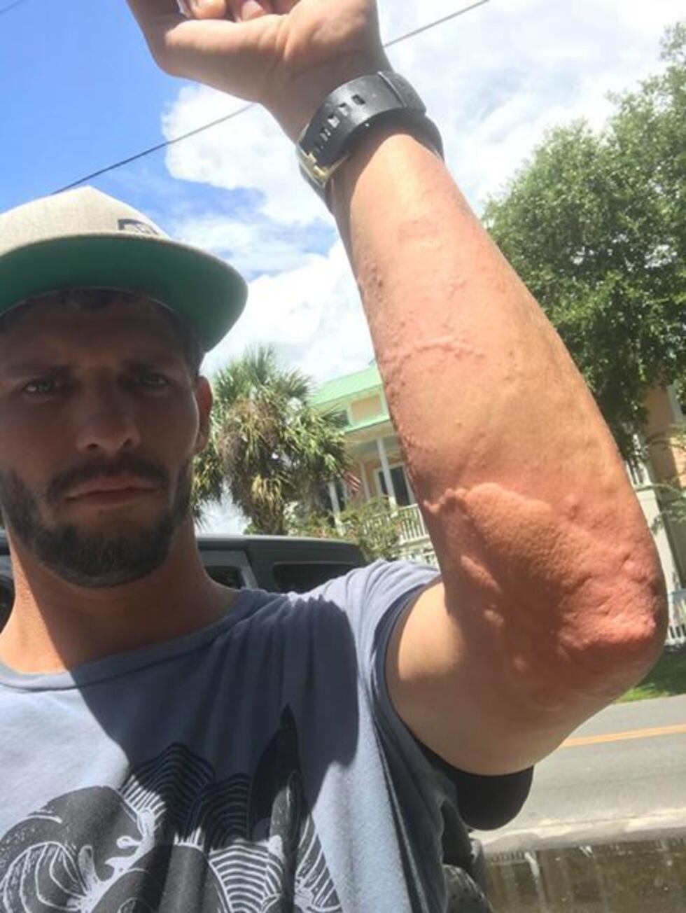 Ryan Godbout sent this picture to us on Wednesday. He said he was stung by a Man o war on...